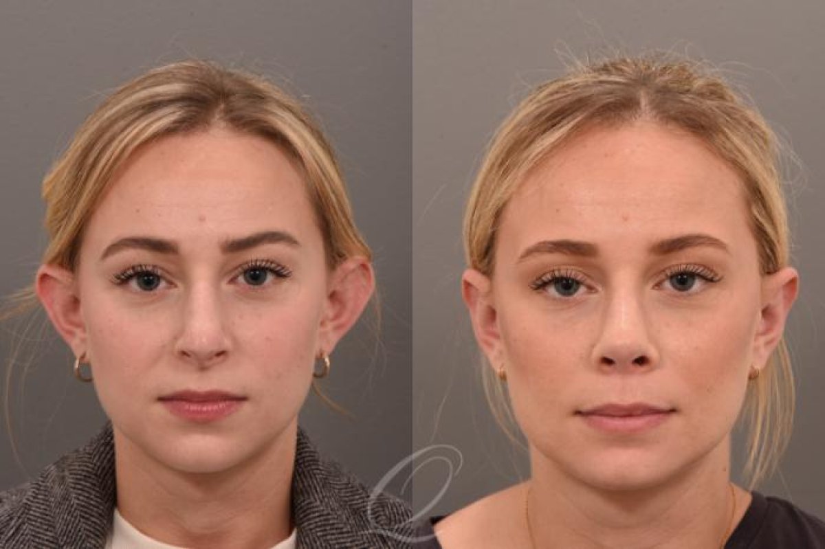 نتائج تجميل الأذن قبل وبعد في عيادة Veselibu – تحسين شكل وأذن متناسقة