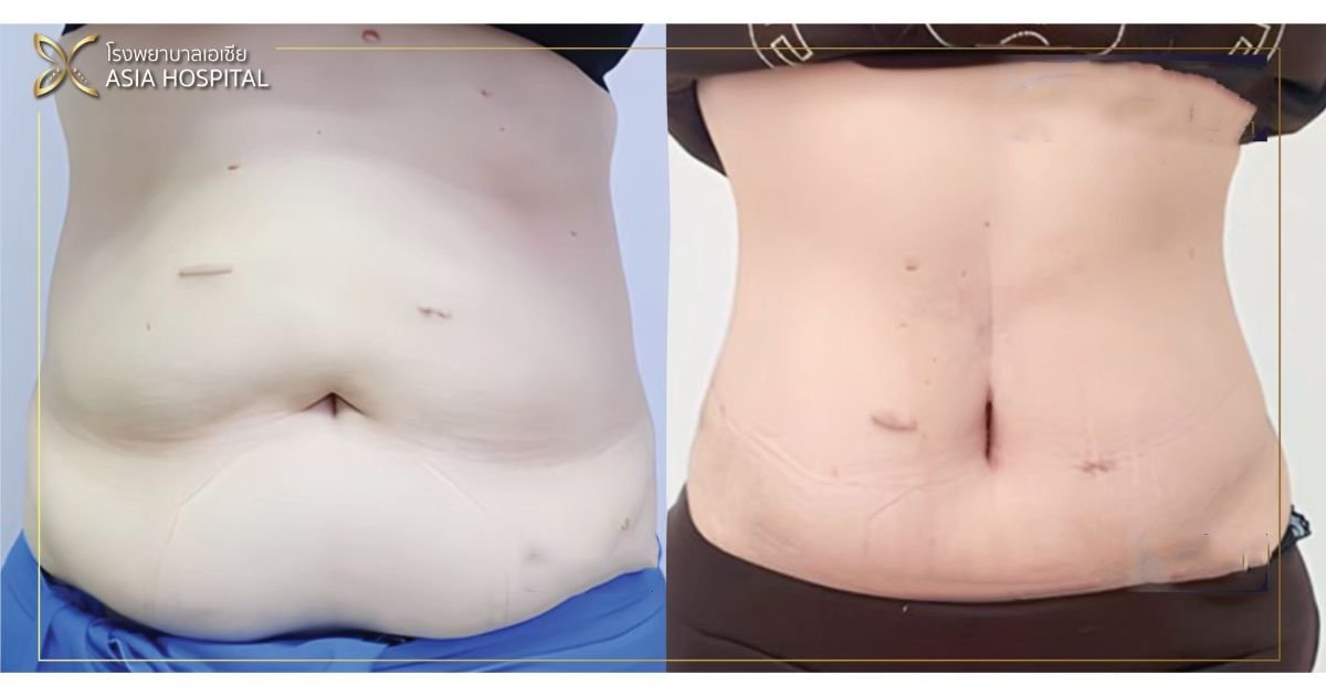 Before and after Vaser lipo 3 areas plus tummy tuck results at Asia Cosmetic Hospital