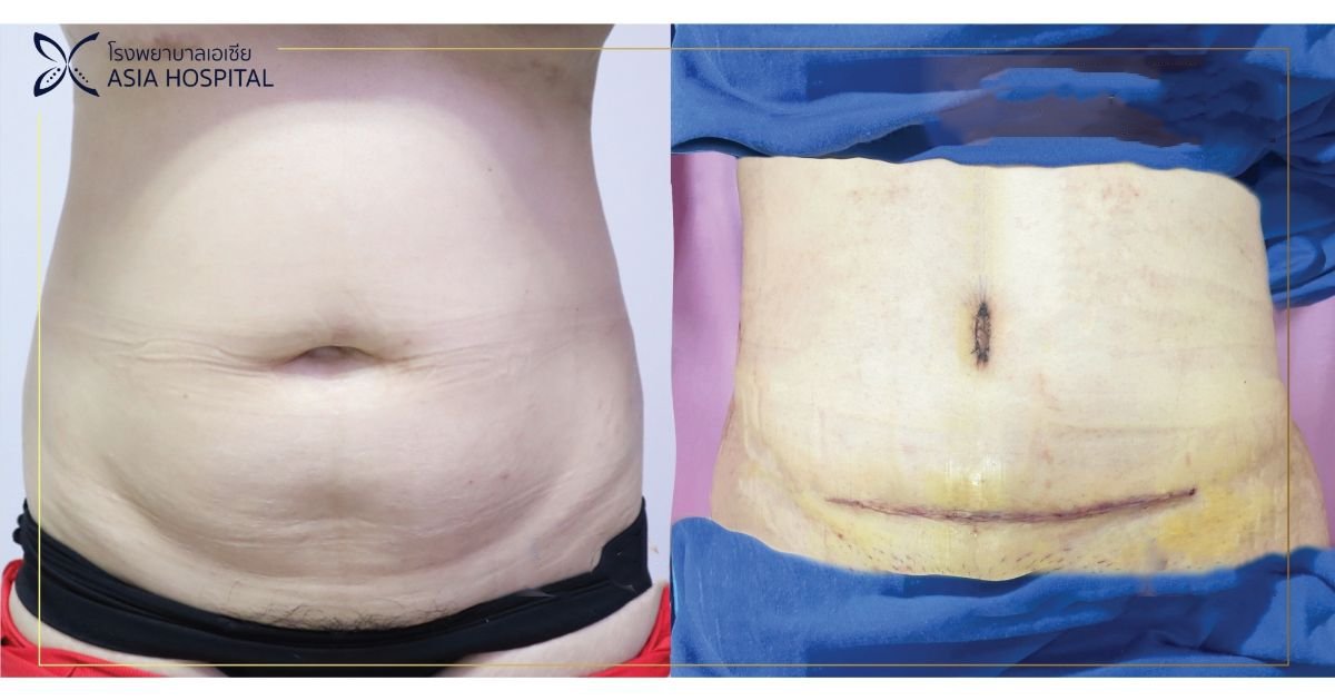 Before and after results of Vaser 3 Areas plus tummy tuck at Asia Cosmetic Hospital, abdomen contour