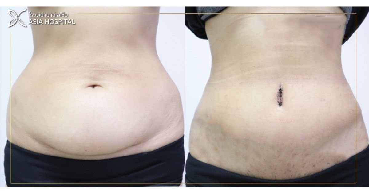 Vorher-nachher-Ergebnis Vaser 3 Zonen plus Bauchdeckenstraffung bei Asia Cosmetic Hospital, flacher Bauch