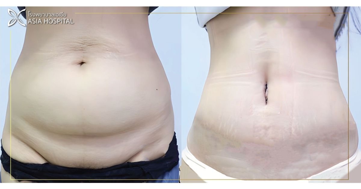 Vorher-nachher-Ergebnis Vaser 3 Zonen plus Bauchdeckenstraffung bei Asia Cosmetic Hospital, flacher Bauch