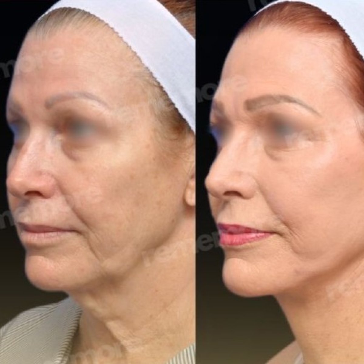 Before and after facial fat transfer at Memorial Şişli Hospital, visible rejuvenation results