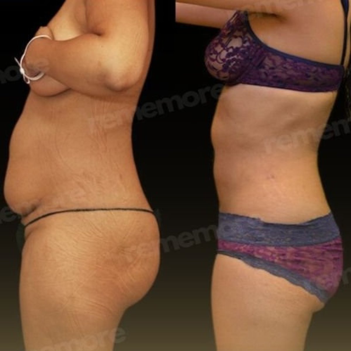 Resultados antes y después de liposucción Vaser en Memorial Bahçelievler Hospital, contorno corporal