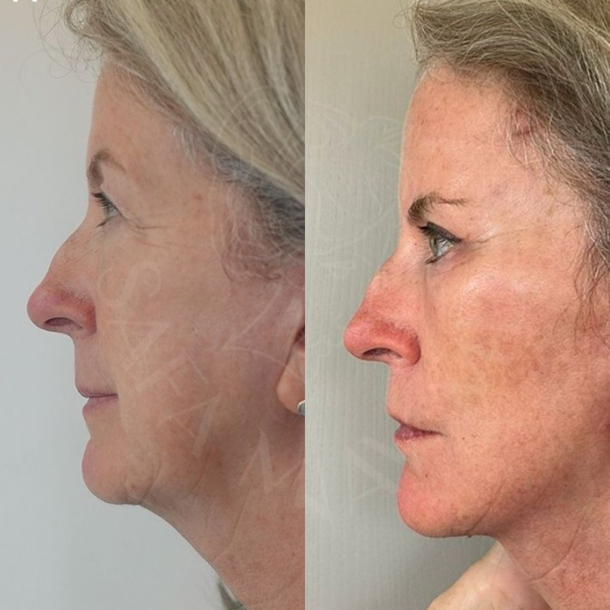 Facelift before and after results at Dr. Safa Manav Clinic, visible facial tightening effect