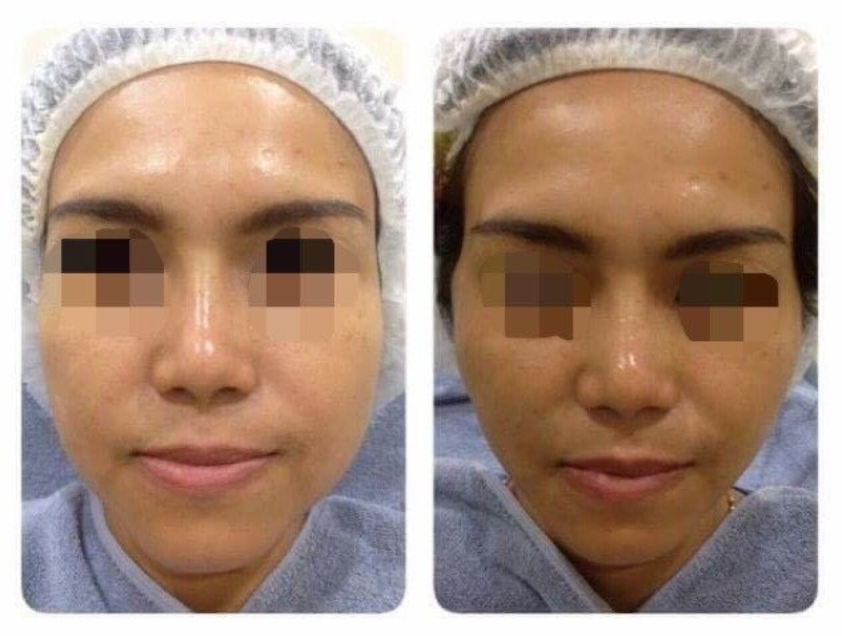 Ultherapy before and after results at Asia Cosmetic Hospital, non-surgical facial skin tightening