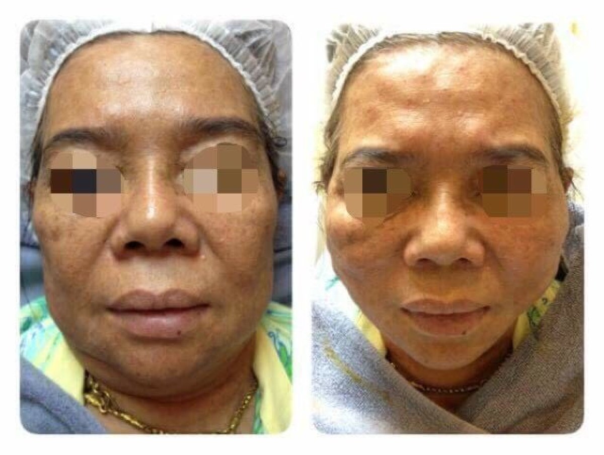 Ultherapy before and after results at Asia Cosmetic Hospital, non-surgical facial skin tightening