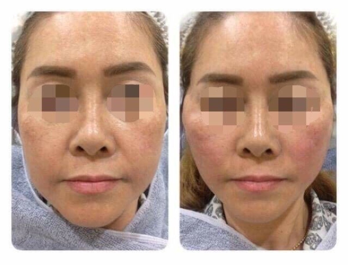 Ultherapy before and after results at Asia Cosmetic Hospital, visible facial skin tightening