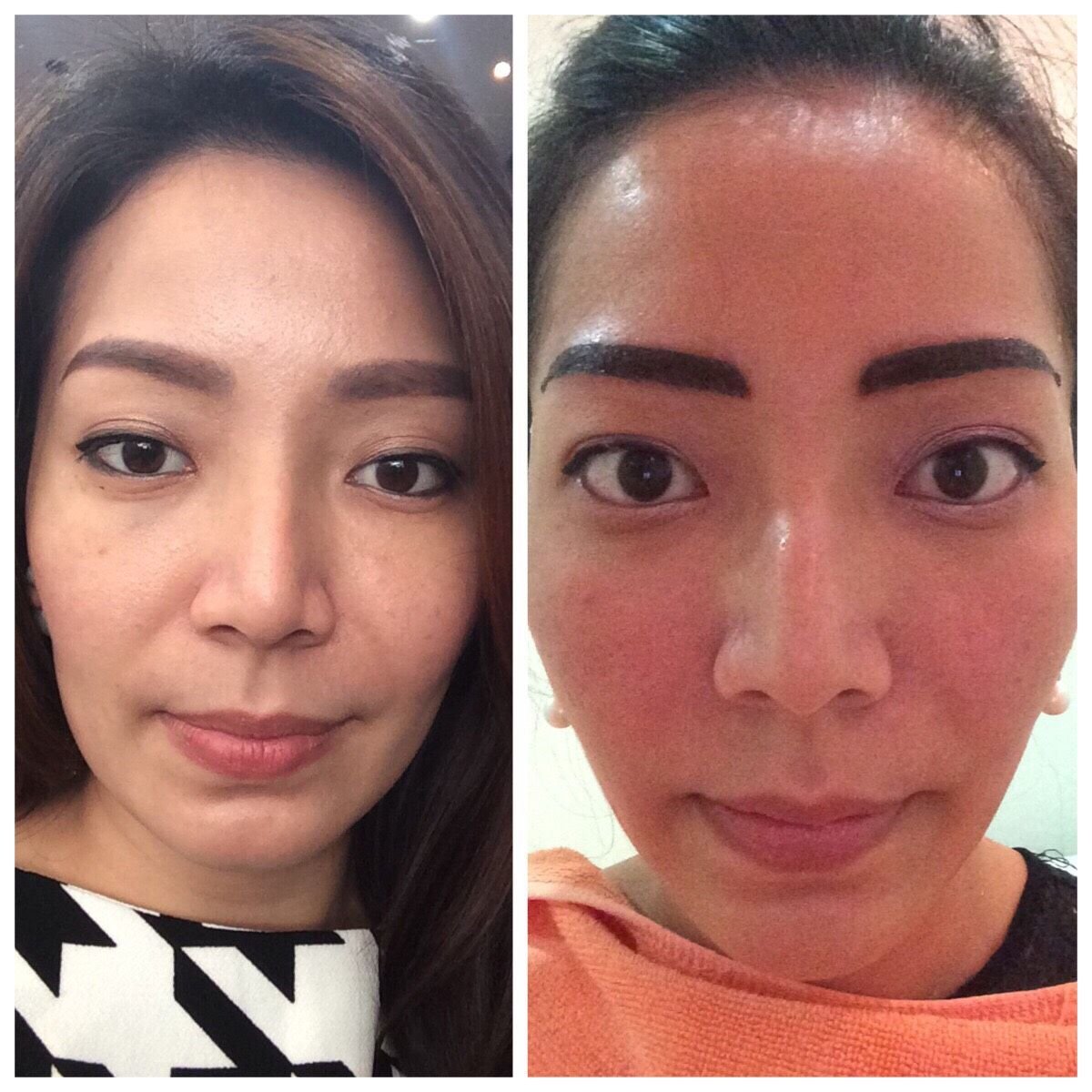 Before and after Ultherapy results at Asia Cosmetic Hospital, facial skin tightening procedure