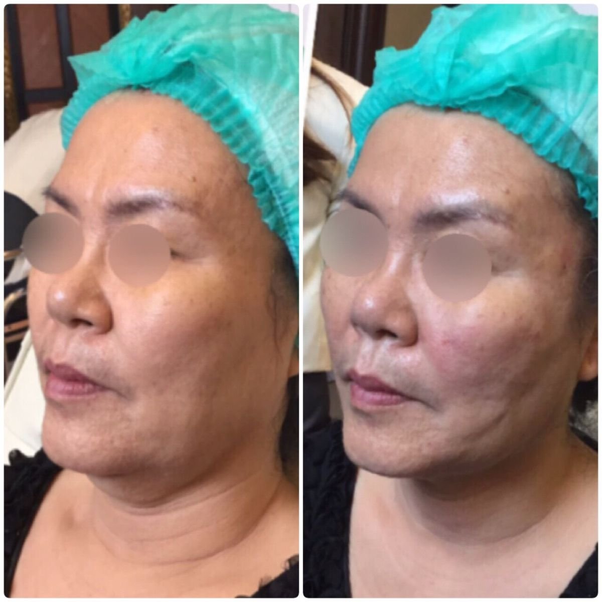 Before and after Ultherapy results at Asia Cosmetic Hospital, visible facial skin tightening