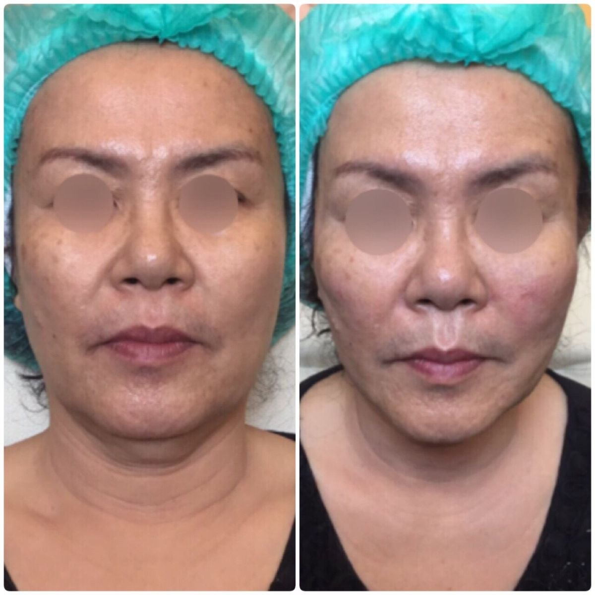 Ultherapy before and after results at Asia Cosmetic Hospital, non-surgical facial skin tightening