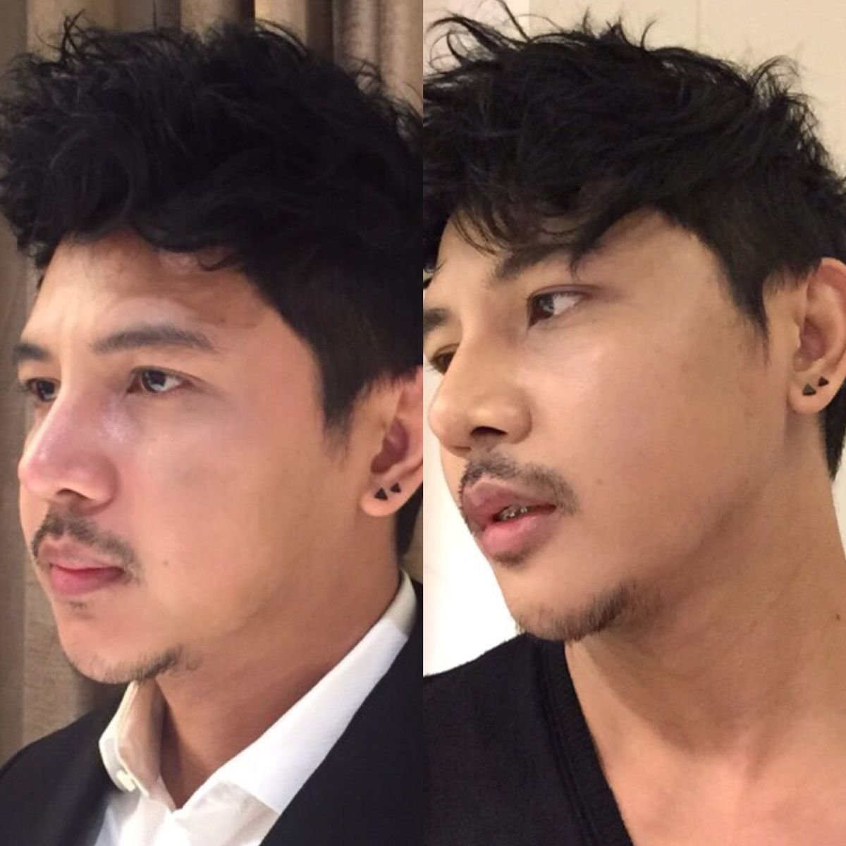Before and after Ultherapy results at Asia Cosmetic Hospital, visible jawline and skin tightening