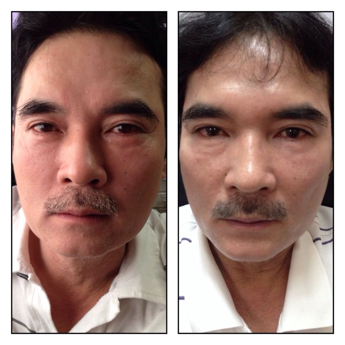 نتائج قبل وبعد علاج Ultherapy في Asia Cosmetic Hospital، شد واضح لبشرة الوجه