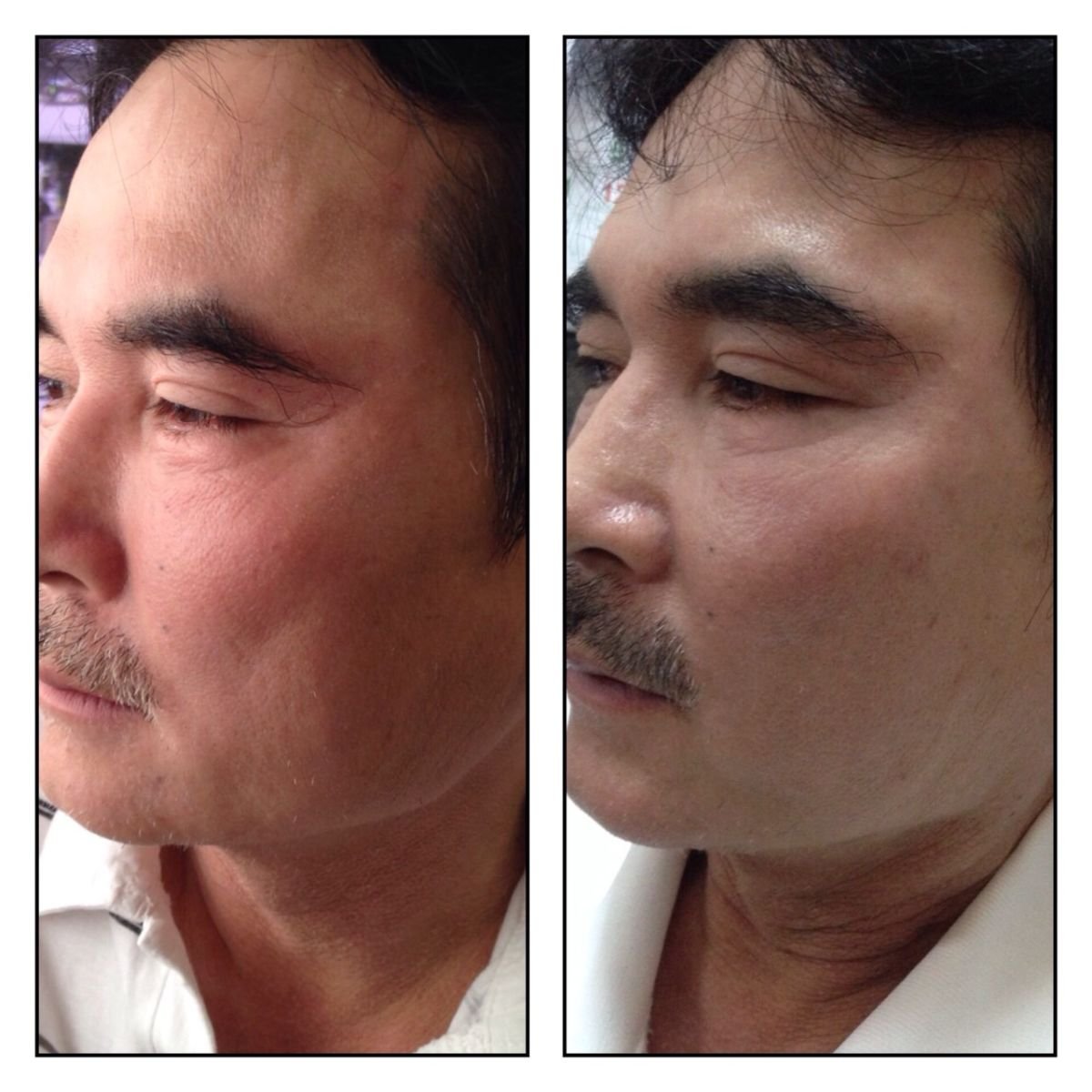 نتائج قبل وبعد علاج Ultherapy في Asia Cosmetic Hospital، شد واضح لبشرة الوجه