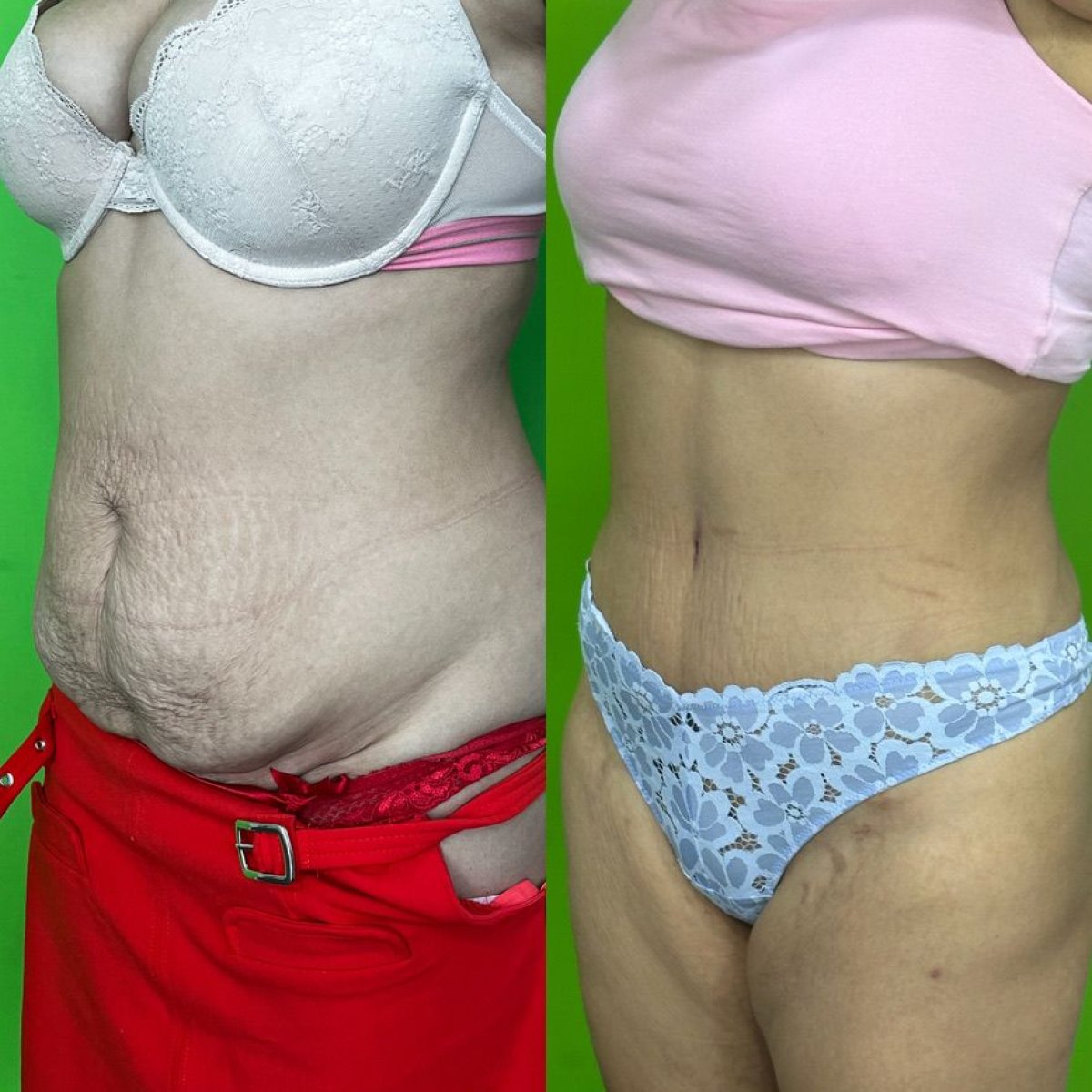 Résultats avant et après liposuccion à la clinique esthétique Prof. Karabekmez