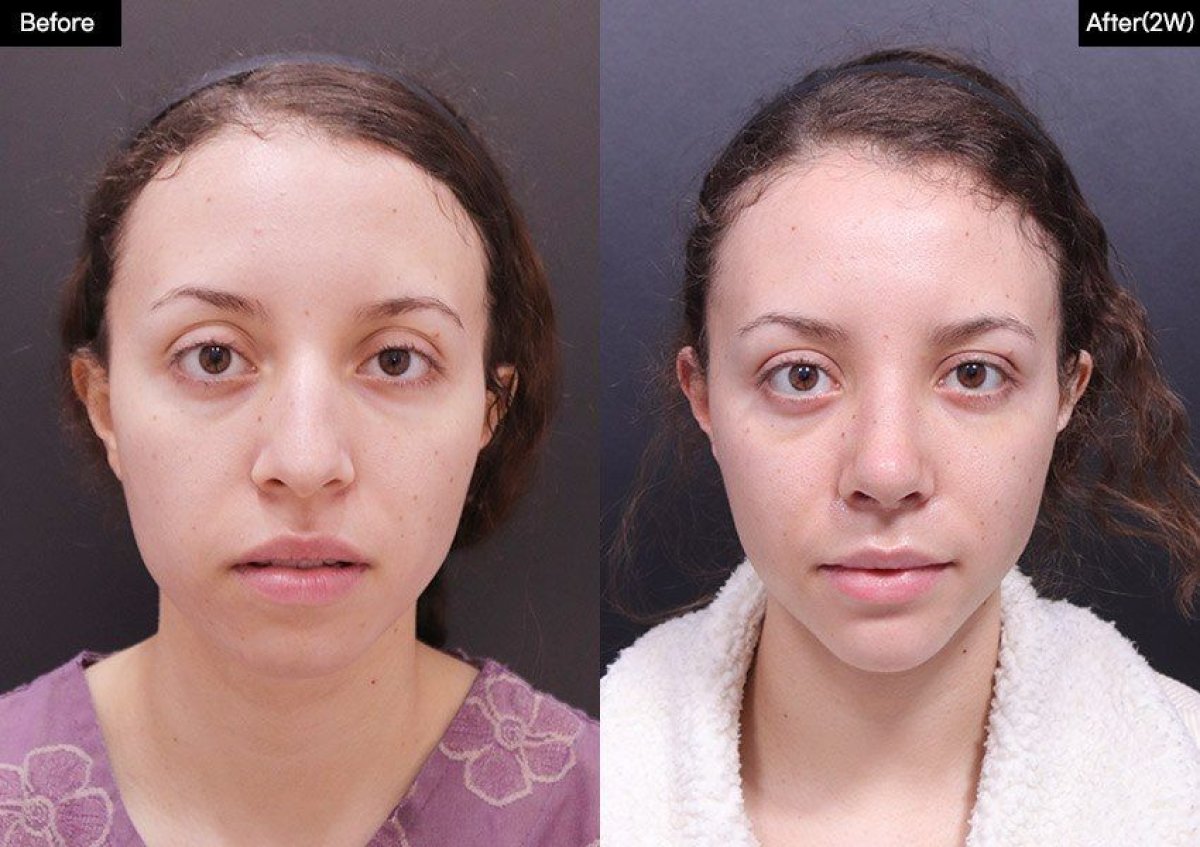 Результати до і після аларпластики у VG Plastic Surgery, покращена форма та симетрія ніздрів