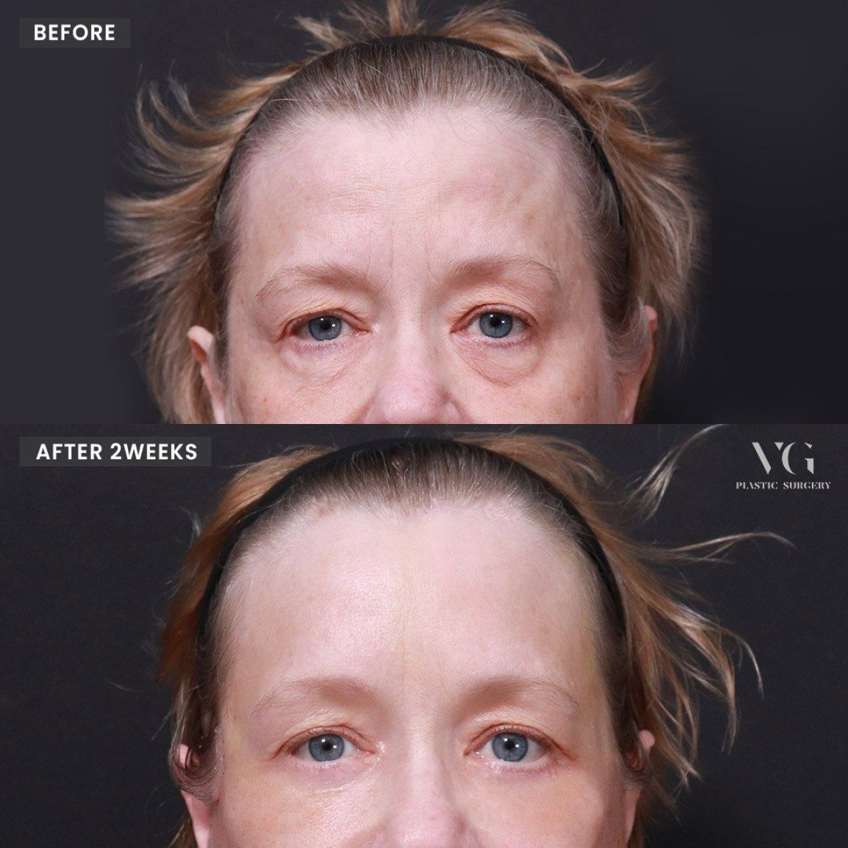 Resultados de blefaroplastia antes y después en VG Plastic Surgery, mejora de párpados