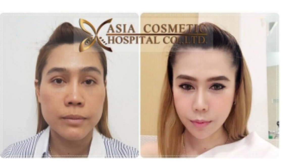 Facial feminization surgery before and after results at Asia Cosmetic Hospital, enhanced femininity