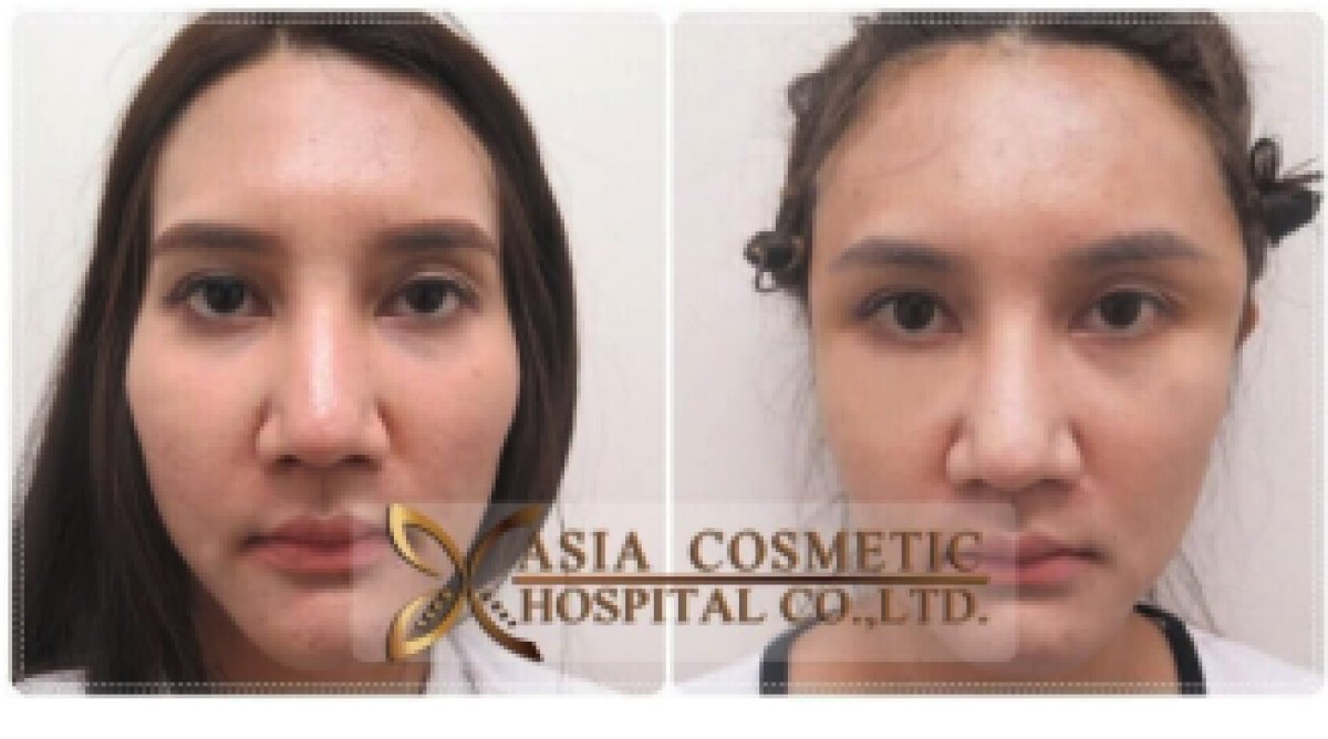 Facial feminization surgery before and after results at Asia Cosmetic Hospital, visible changes