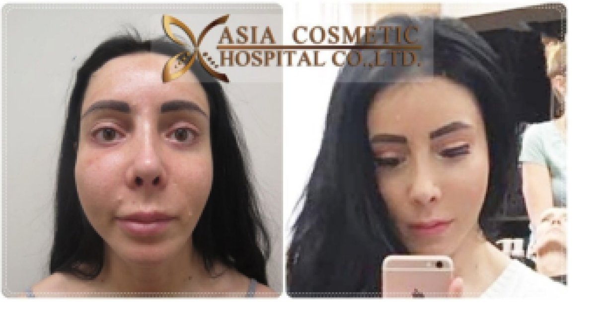 Facial feminization surgery before and after results at Asia Cosmetic Hospital, refined facial features