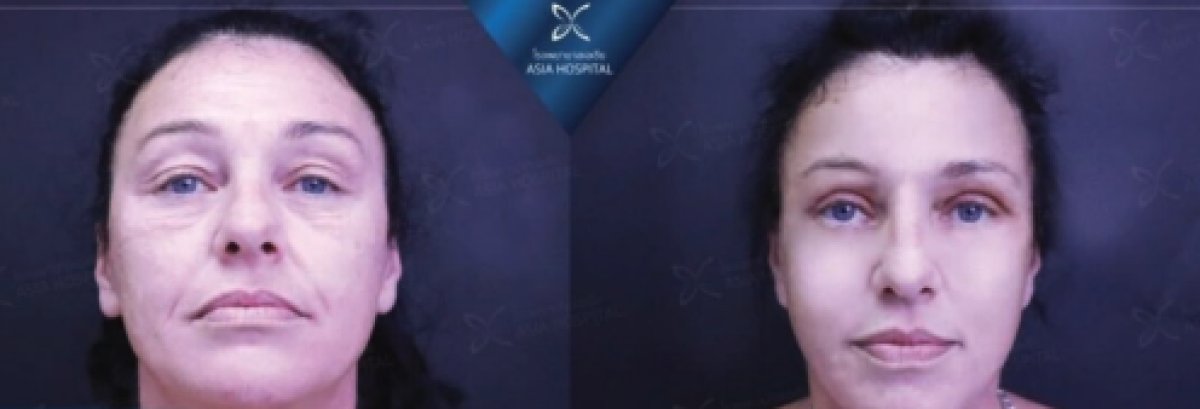 Facial feminization surgery before and after results at Asia Cosmetic Hospital, softer facial features