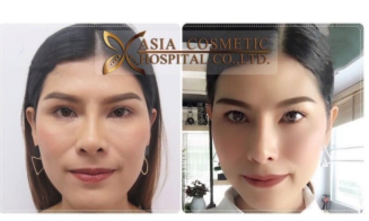 Facial feminization surgery before and after results at Asia Cosmetic Hospital, refined facial features