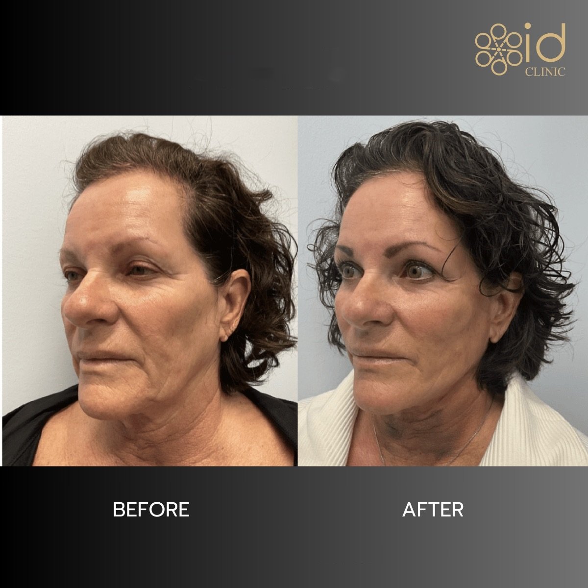 Before and after hyaluronic acid threads lifting results at ID Clinic Bangkok, facial rejuvenation