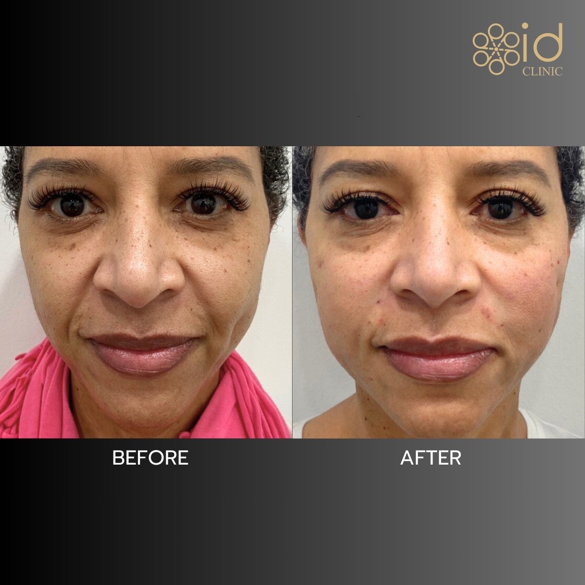 Before and after hyaluronic acid threads lifting results at ID Clinic Bangkok, facial rejuvenation