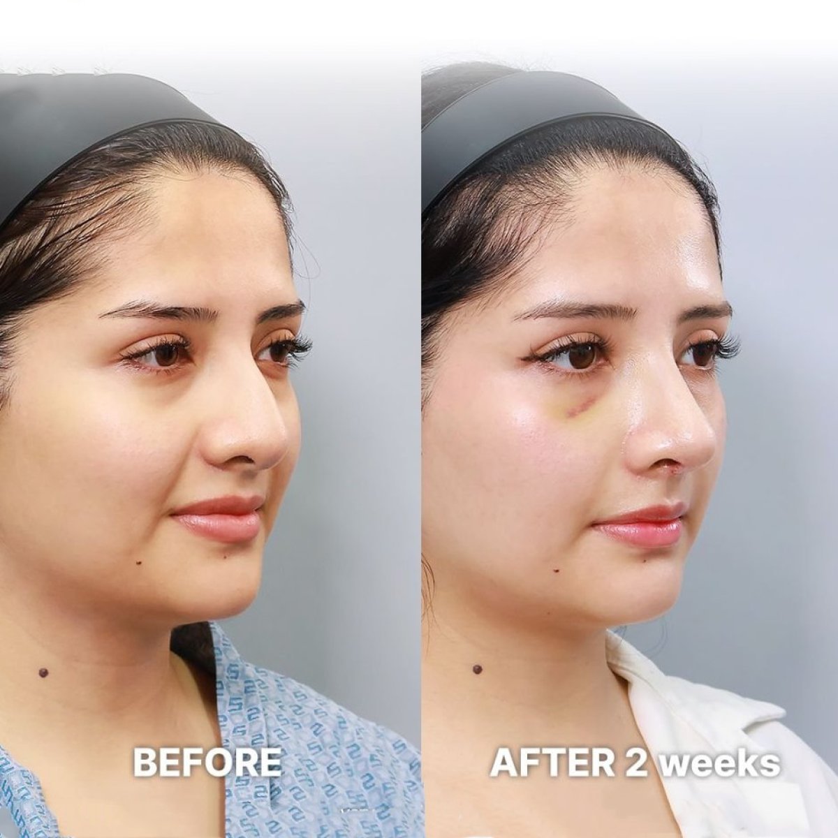 Результаты до и после аллопластики в Returning Plastic Surgery, коррекция носа через 2 недели