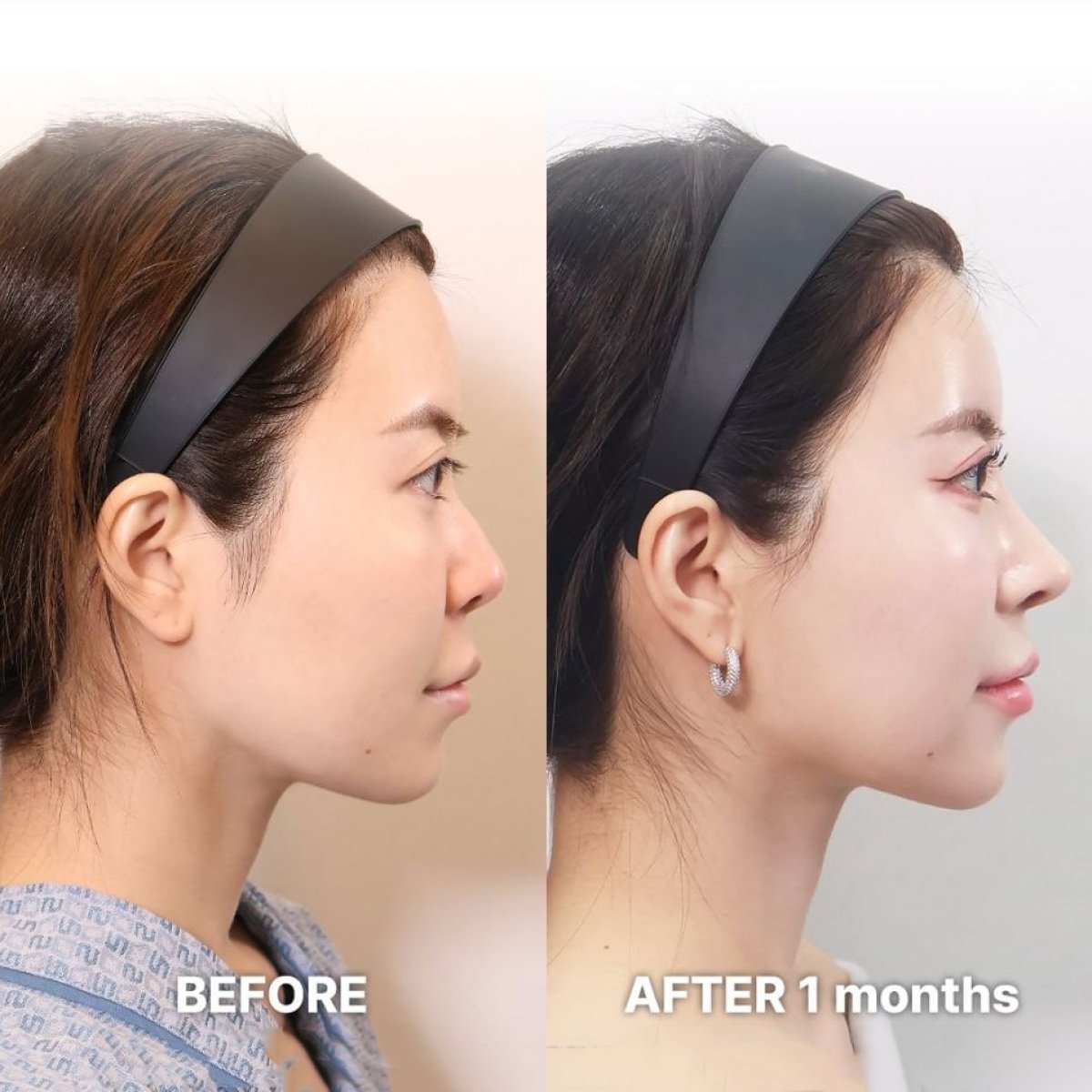 Before and after alarplasty result at Returning Plastic Surgery, improved nose shape in 1 month