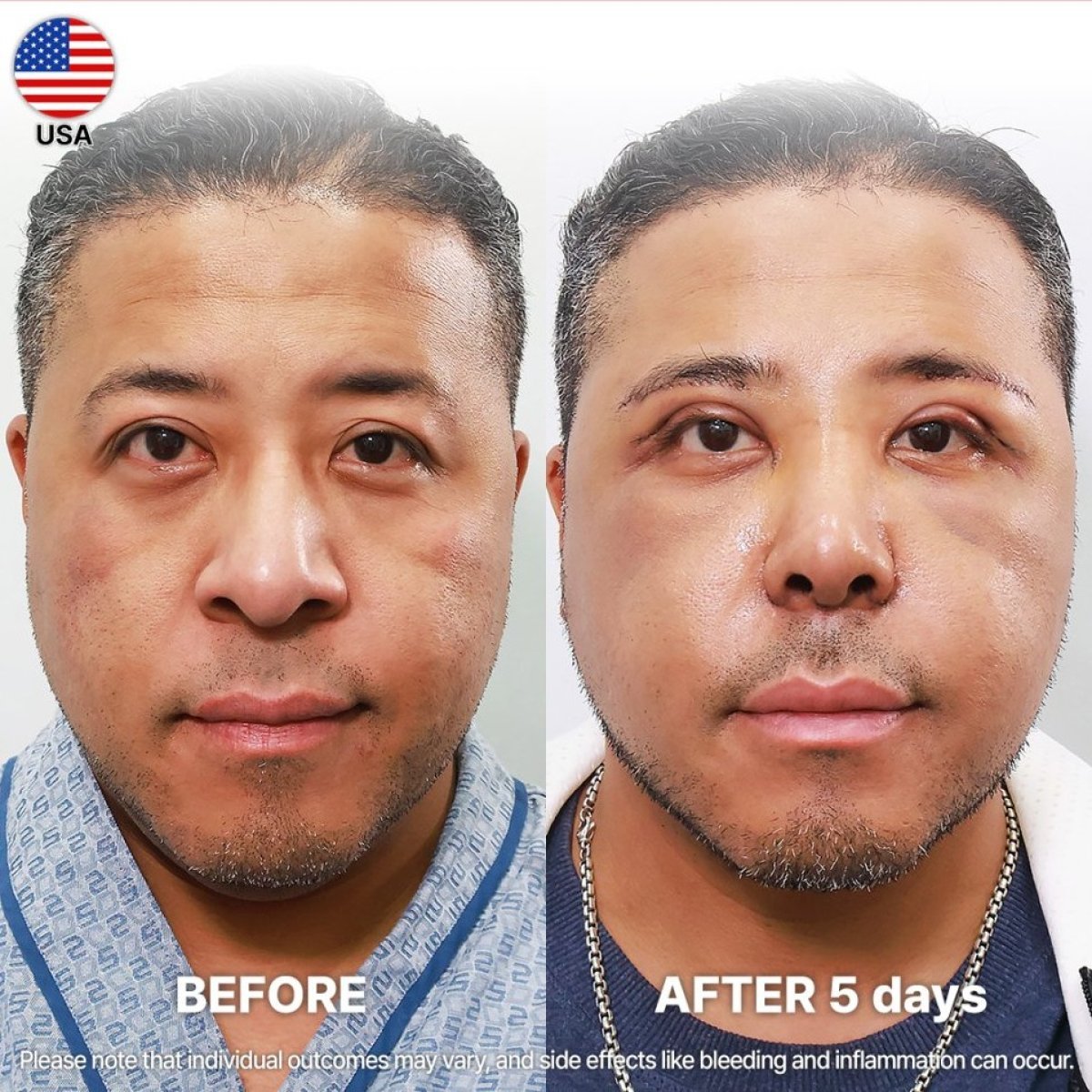Before and after alarplasty results at Returning Plastic Surgery, visible nose reshaping after 5 days