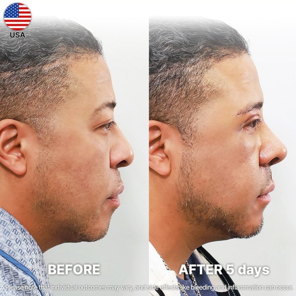 Результати до і після аларпластики в Returning Plastic Surgery, зміна носа через 5 днів