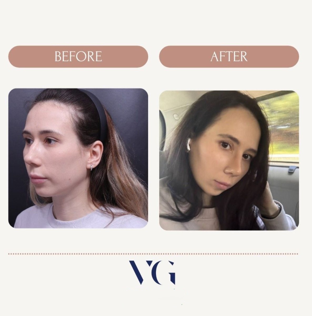 نتائج قبل وبعد تجميل الأنف بالموجات فوق الصوتية في VG Plastic Surgery، إعادة تشكيل الأنف