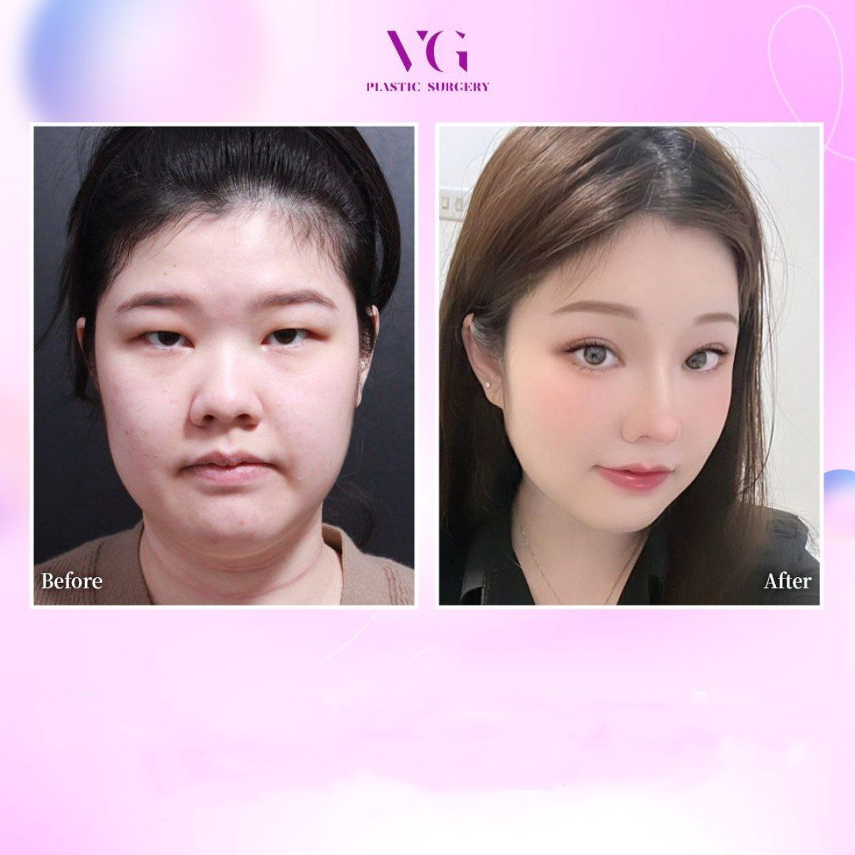 Resultados de lifting de cejas antes y después en VG Plastic Surgery, cejas y ojos mejorados