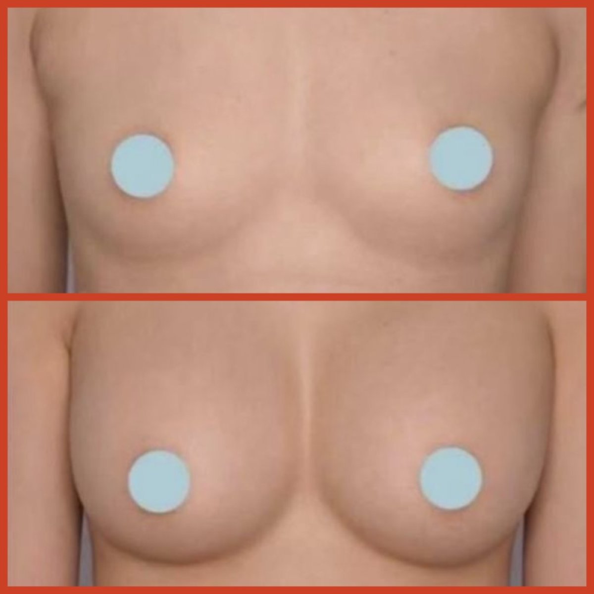 Before and after breast augmentation results at DGB Clinic – enhanced breast volume