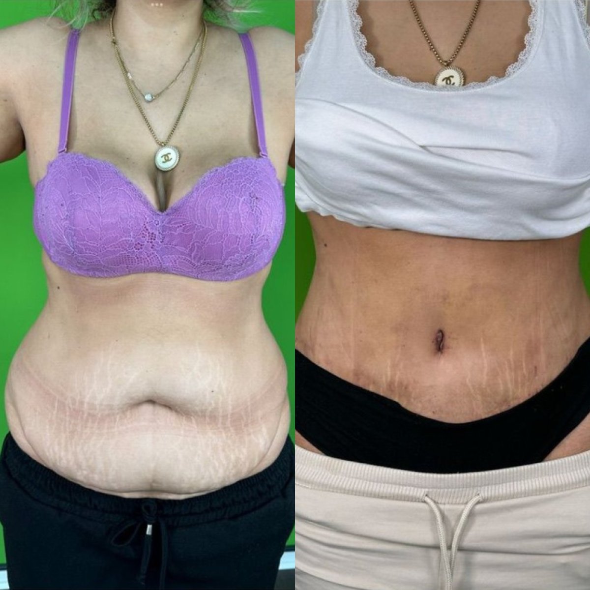 Resultados de liposucción antes y después en la clínica estética del Prof. Karabekmez