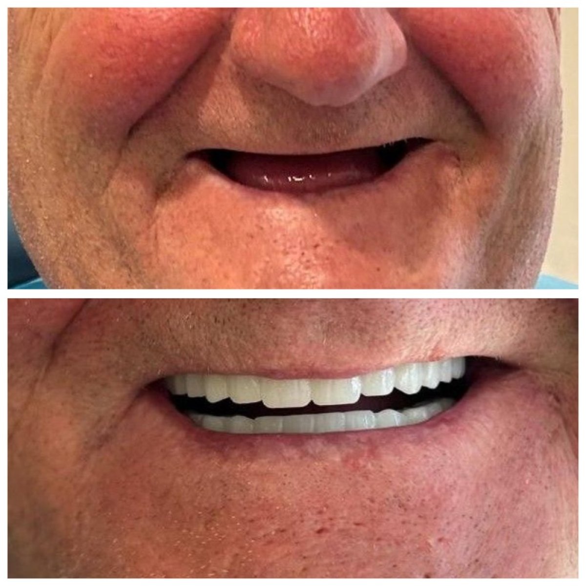 Resultado antes y después de la prótesis dental en Medical Park Antalya Hospital Complex