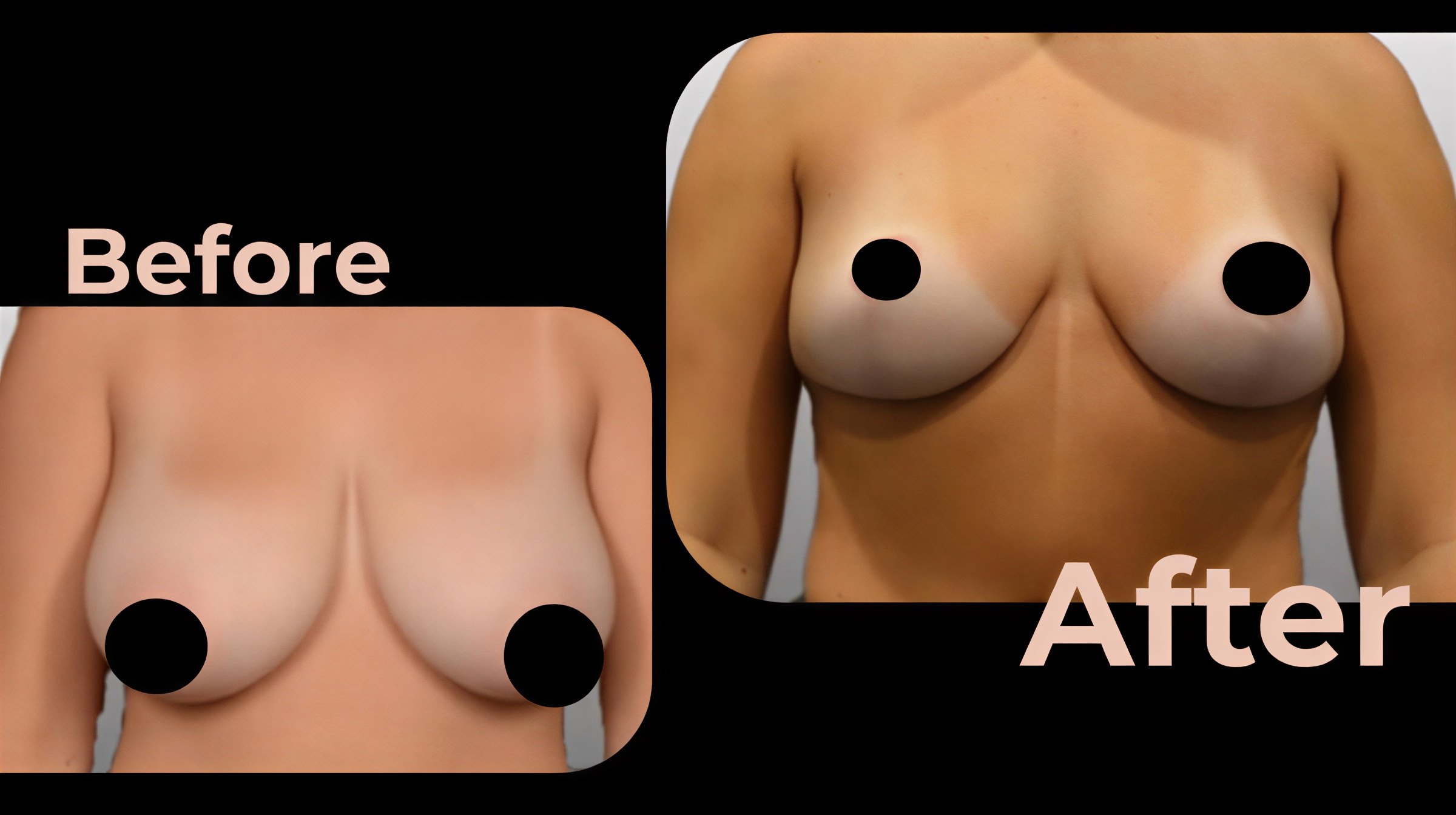 Antes y después de implantes mamarios con lifting en Avicenna International Hospital, mejor contorno
