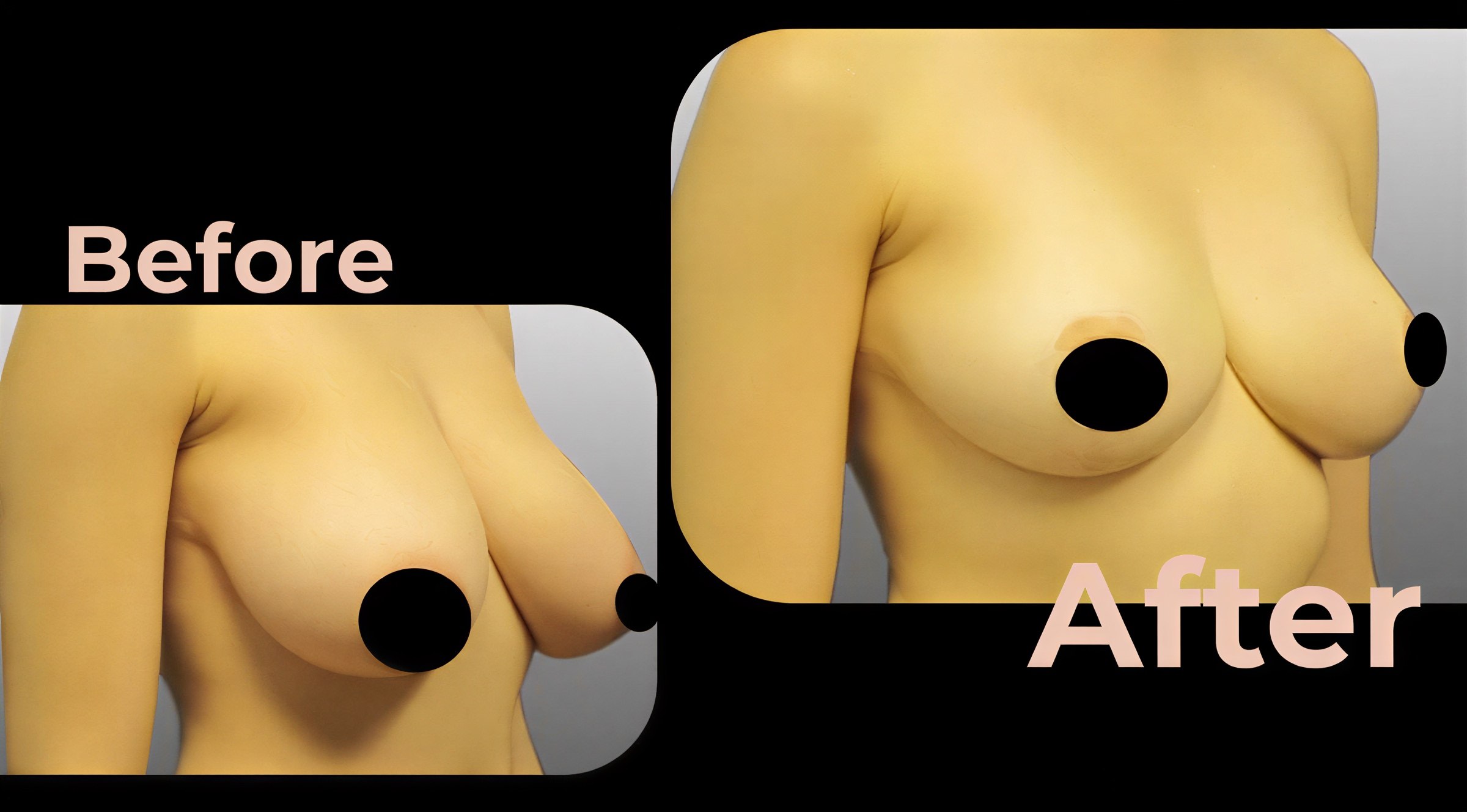 Resultados antes y después de implantes y levantamiento de senos en Avicenna International Hospital