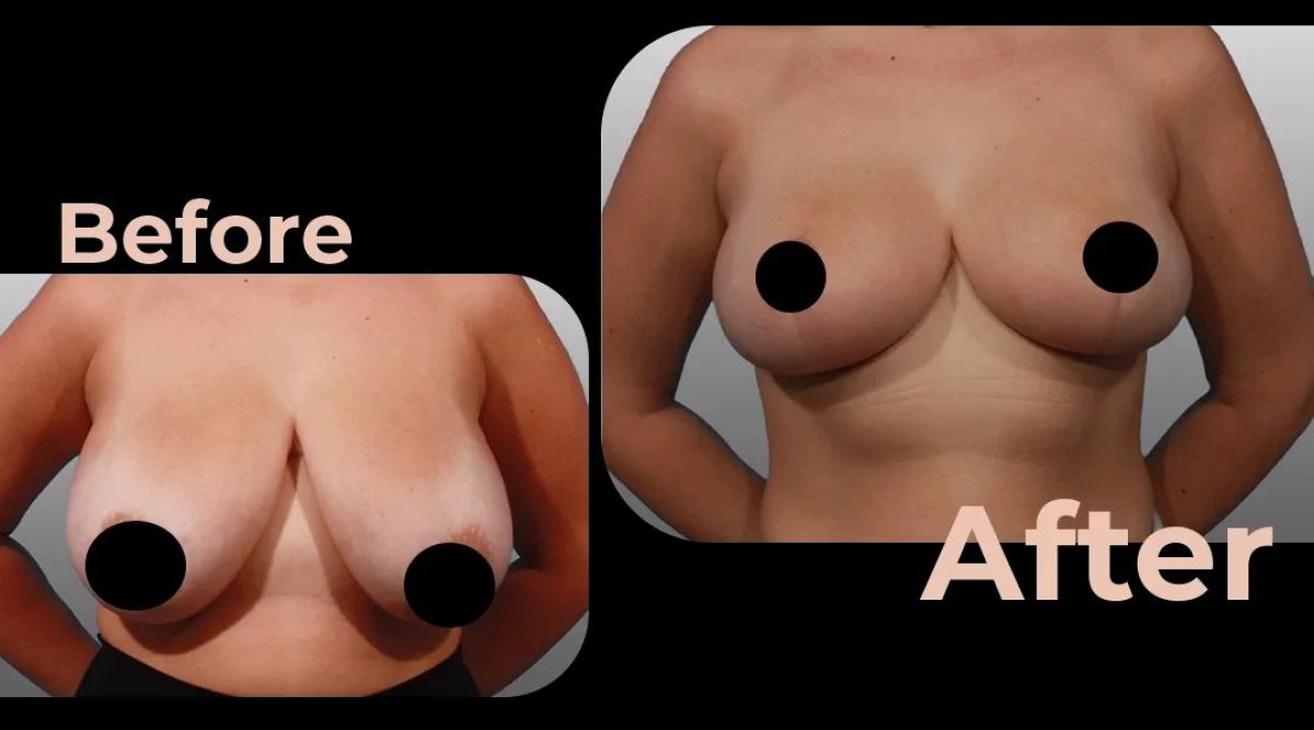 Before and after breast implants with lift results at Avicenna International Hospital