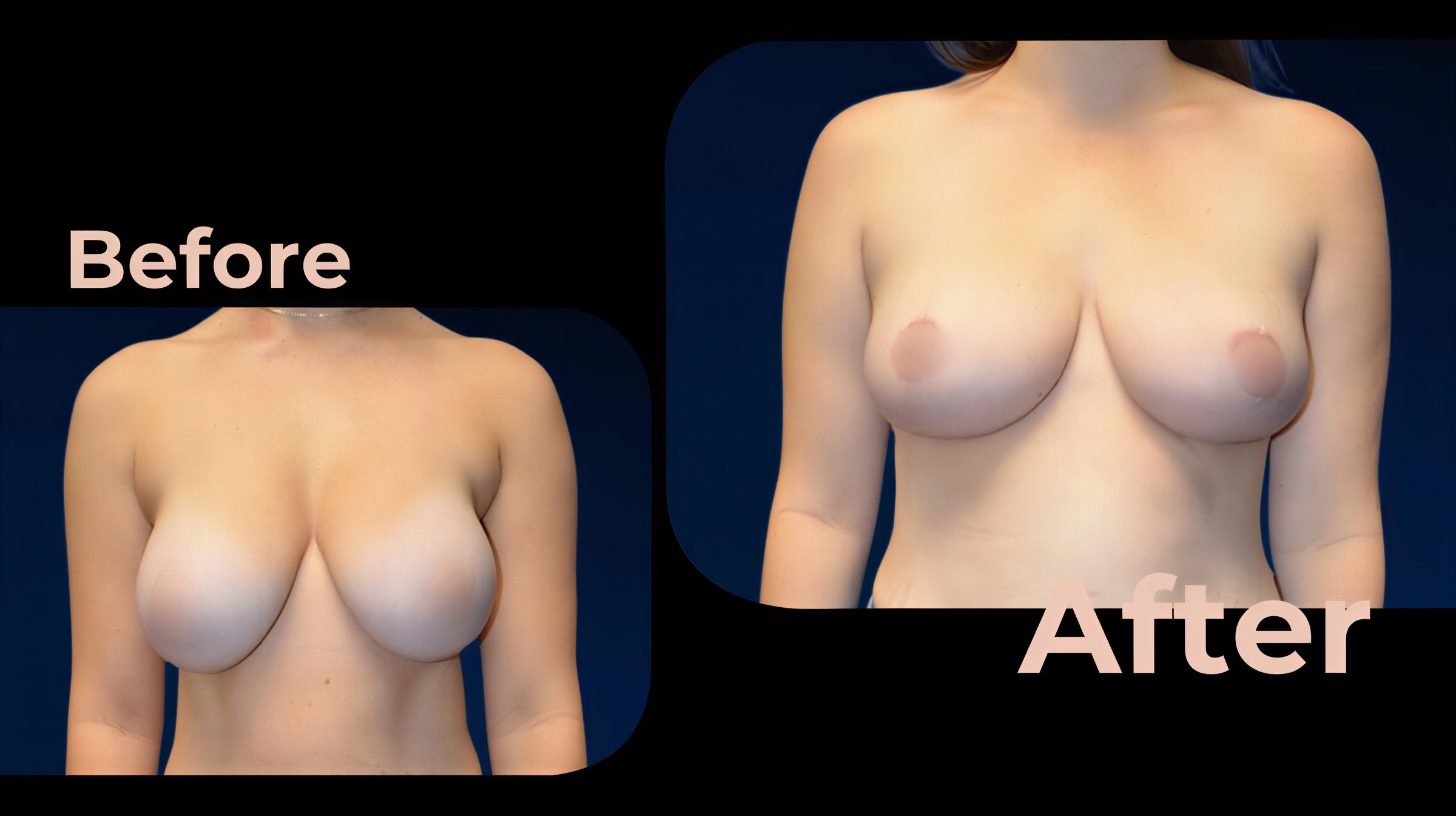 Resultados antes y después de implantes y levantamiento de senos en Avicenna International Hospital