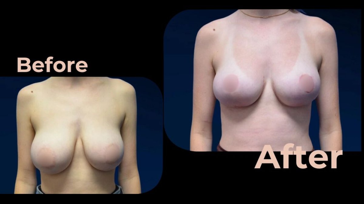 Before and after breast implants with lift at Avicenna International Hospital, enhanced contour result