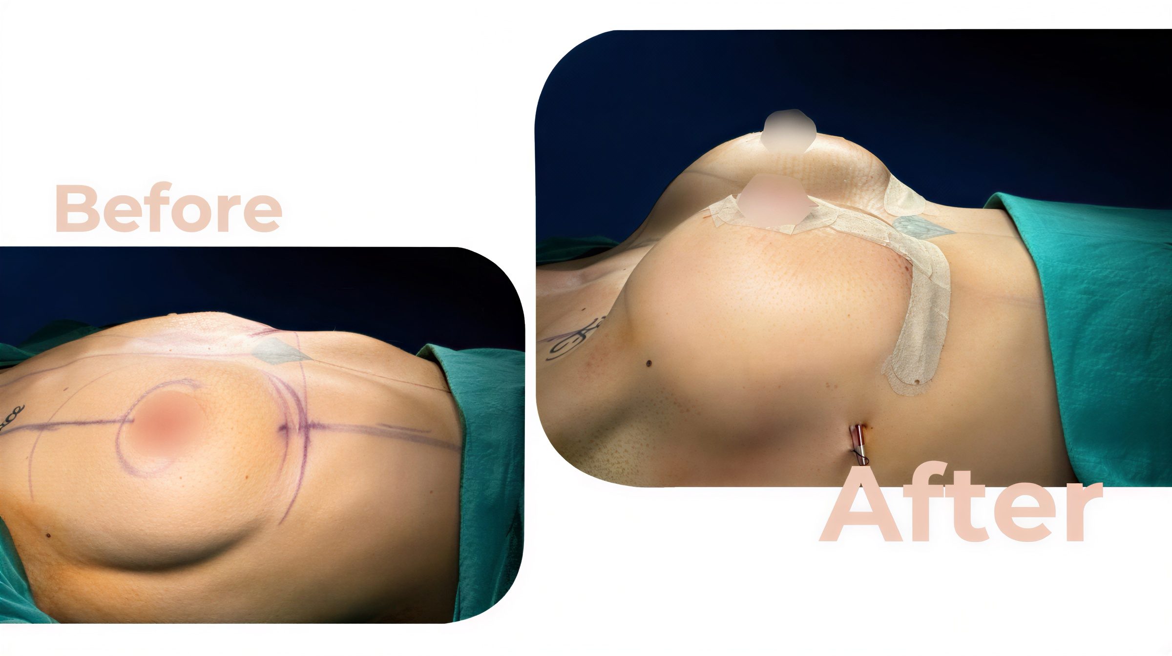Resultados antes y después de implantes y levantamiento de senos en Avicenna International Hospital