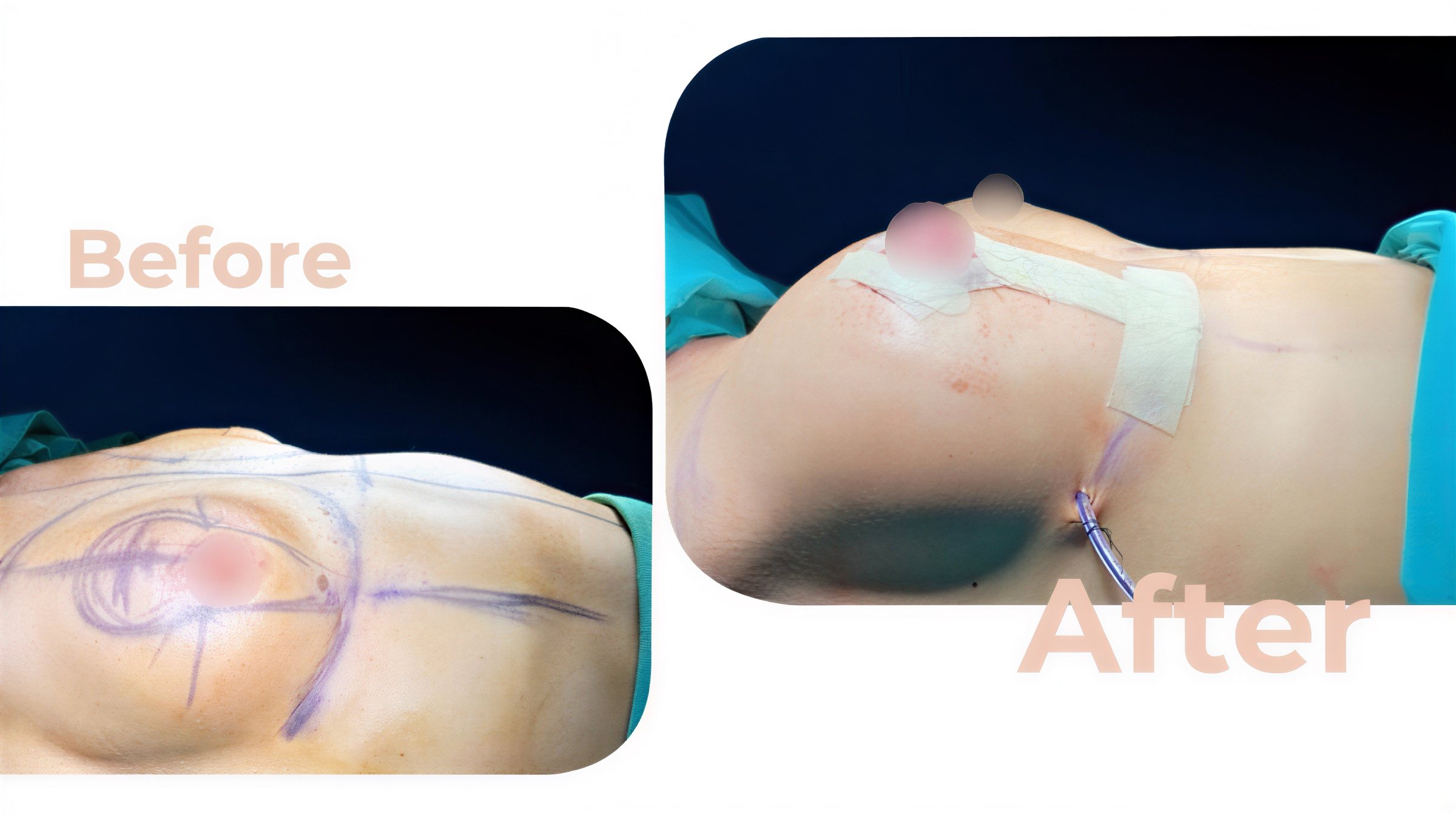 Resultados antes y después de implantes y levantamiento de senos en Avicenna International Hospital
