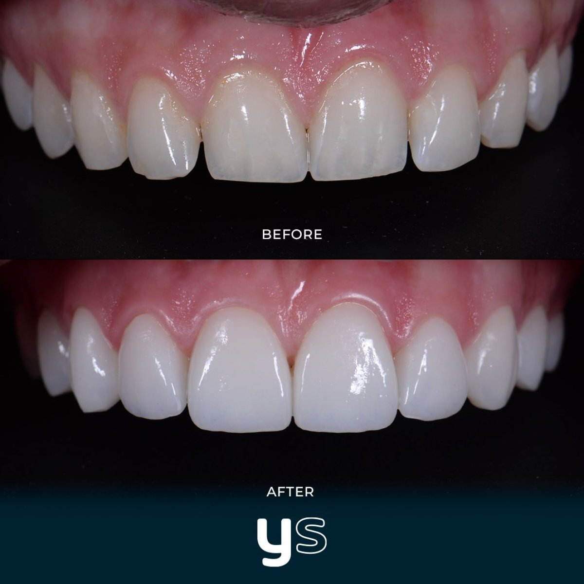 Vorher-nachher-Ergebnis der Zahnfleischchirurgie bei YeahSmile – verbesserte Zahnfleischlinie