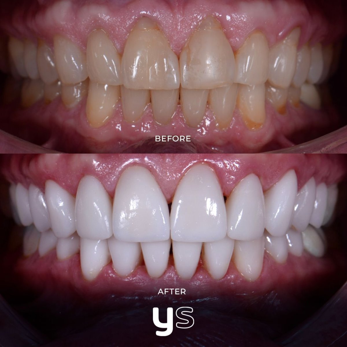 Résultats avant/après chirurgie des gencives chez YeahSmile – ligne gingivale améliorée