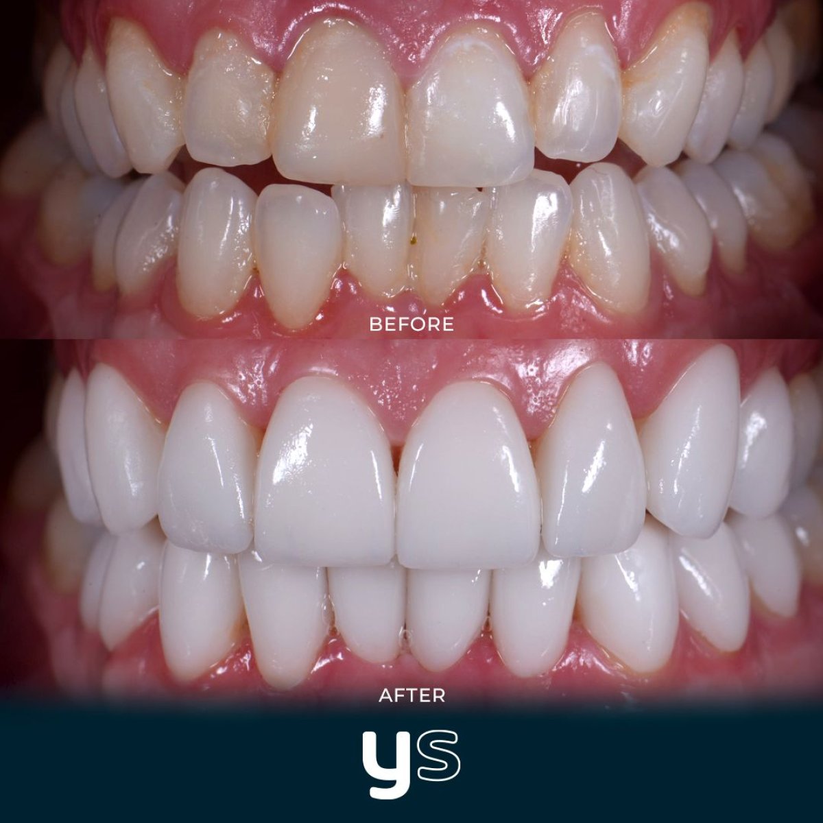 نتائج قبل وبعد جراحة اللثة في YeahSmile – خط لثة محسن وأسنان أكثر بياضًا
