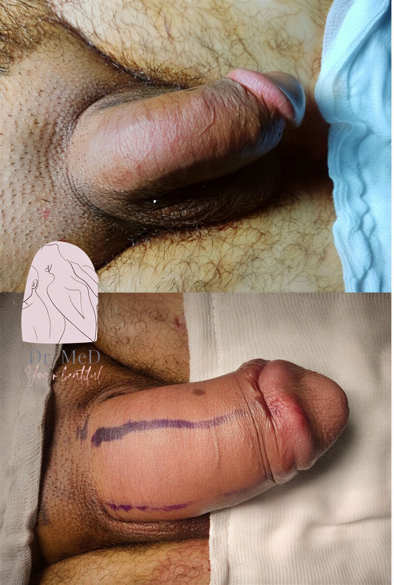 نتائج الفالوبلاستي قبل وبعد في Dr. MED – تحسين وتحديد شكل القضيب