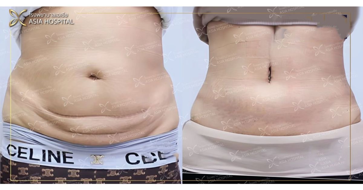 Результаты абдоминопластики до и после в ASIA CLINIC – более плоский живот