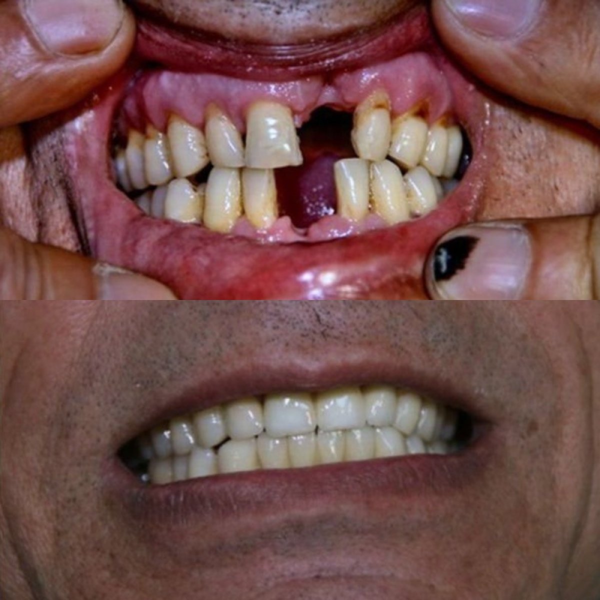 قبل وبعد زراعة الأسنان مع التاج في Smile Centrum – نتيجة ابتسامة مستعادة