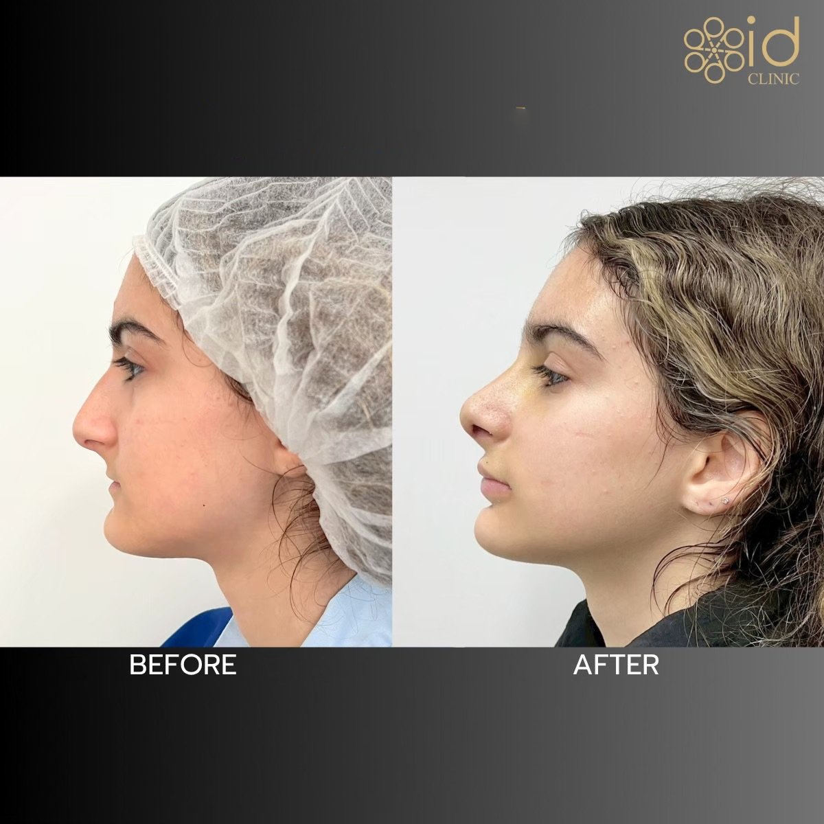 Resultados de rinoplastia antes y después en ID Clinic Bangkok, nariz de aspecto natural